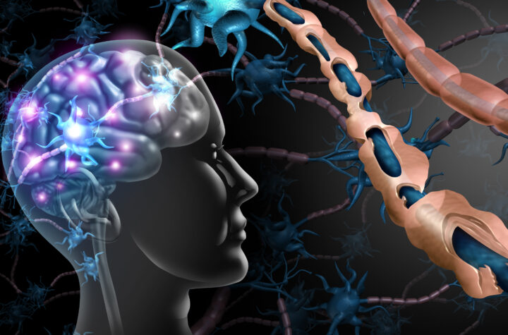 multiple sclerosis biotech stocks